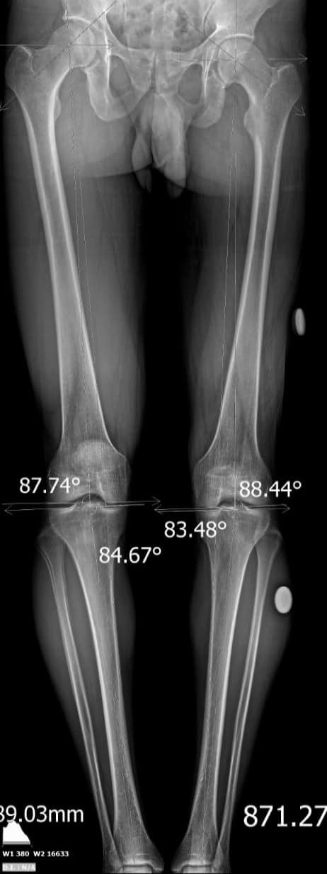 Scanogram of lower limb AP view in standing position اشعة سكانوجرام ...