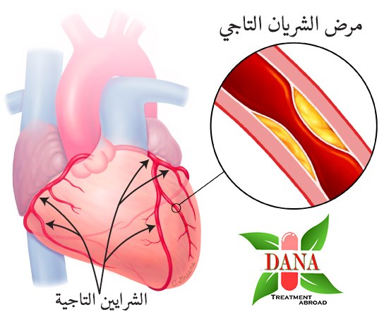 دانة للخدمات الطبية و العلاج بالخارج مــــرض الــشــريــان الــتــاجـي ا Coronary Artery Disease هو تلف الأوعية الدموية الرئيسية التي تزود القلب بالدم والأكسجين والعناصر المغذية الشرايين