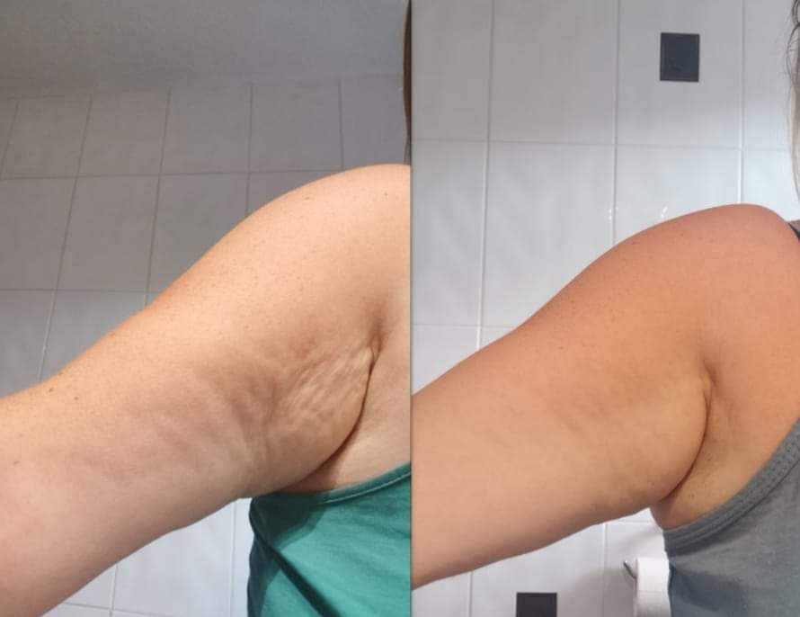 Who suffers with sagging up arms like... - Beauty, Body & You