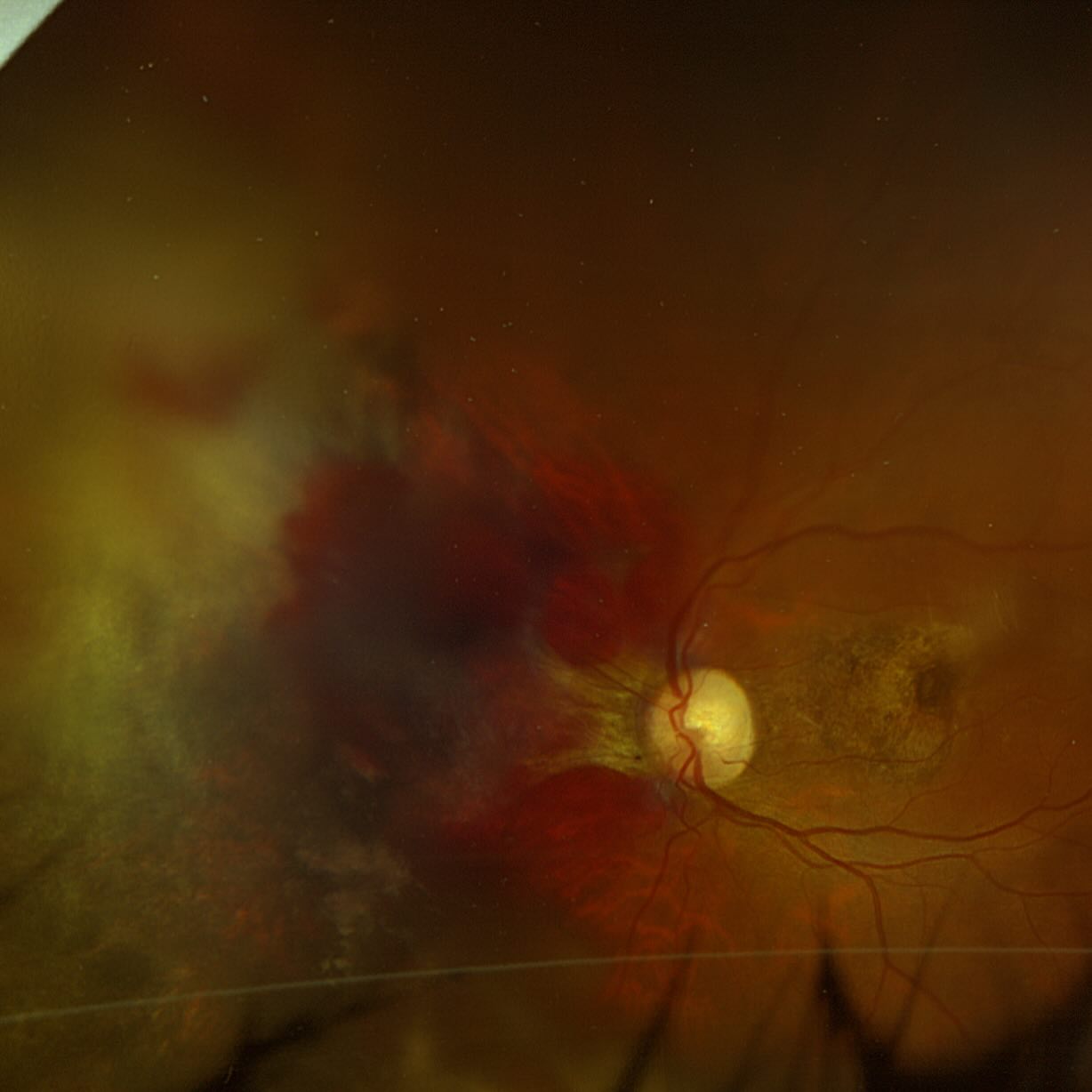 Rehan - #Sclopetaria (Chorioretinitis Sclopetaria) is a severe eye ...