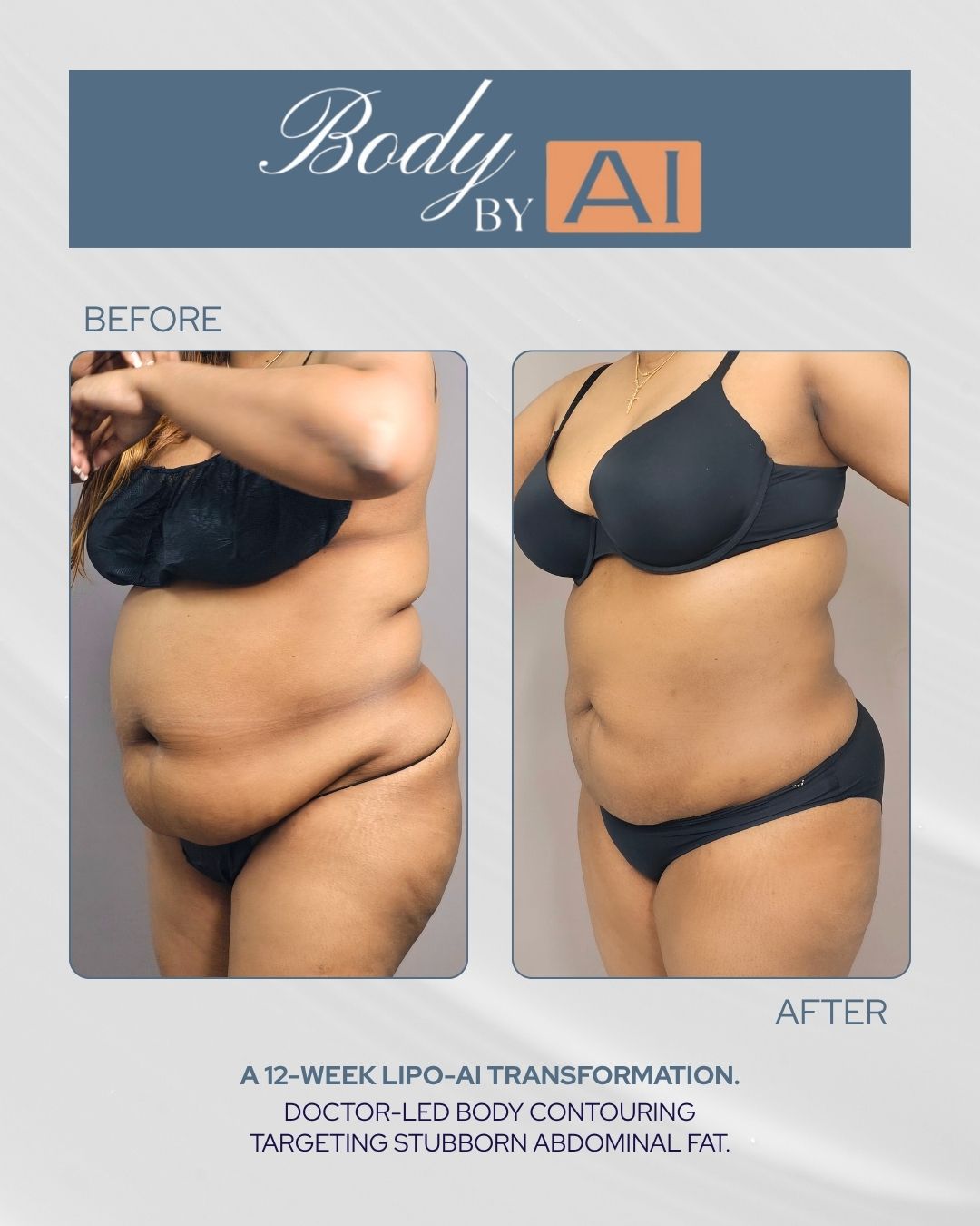 lipo c injection before and after stomach shot Check out this amazing transformation Liquid of her back , ., Book- Coretta, NP-C via link in bio or Abdomen Liposuction Photos - Before
