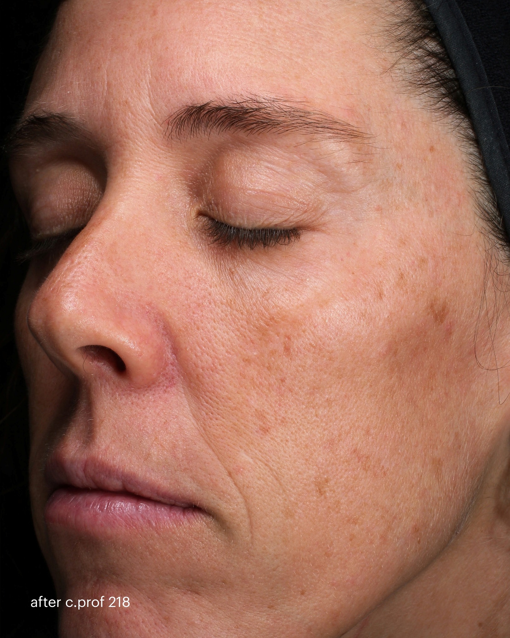 glutathione for acne treatment Swipe to see the results of axion combined with our new c.prof 218 depigmentation solution. Formulated with soy bean exosomes, PDRN, vitamin C, tranexamic acid, idebenone and to unify skin tone natural fragrance