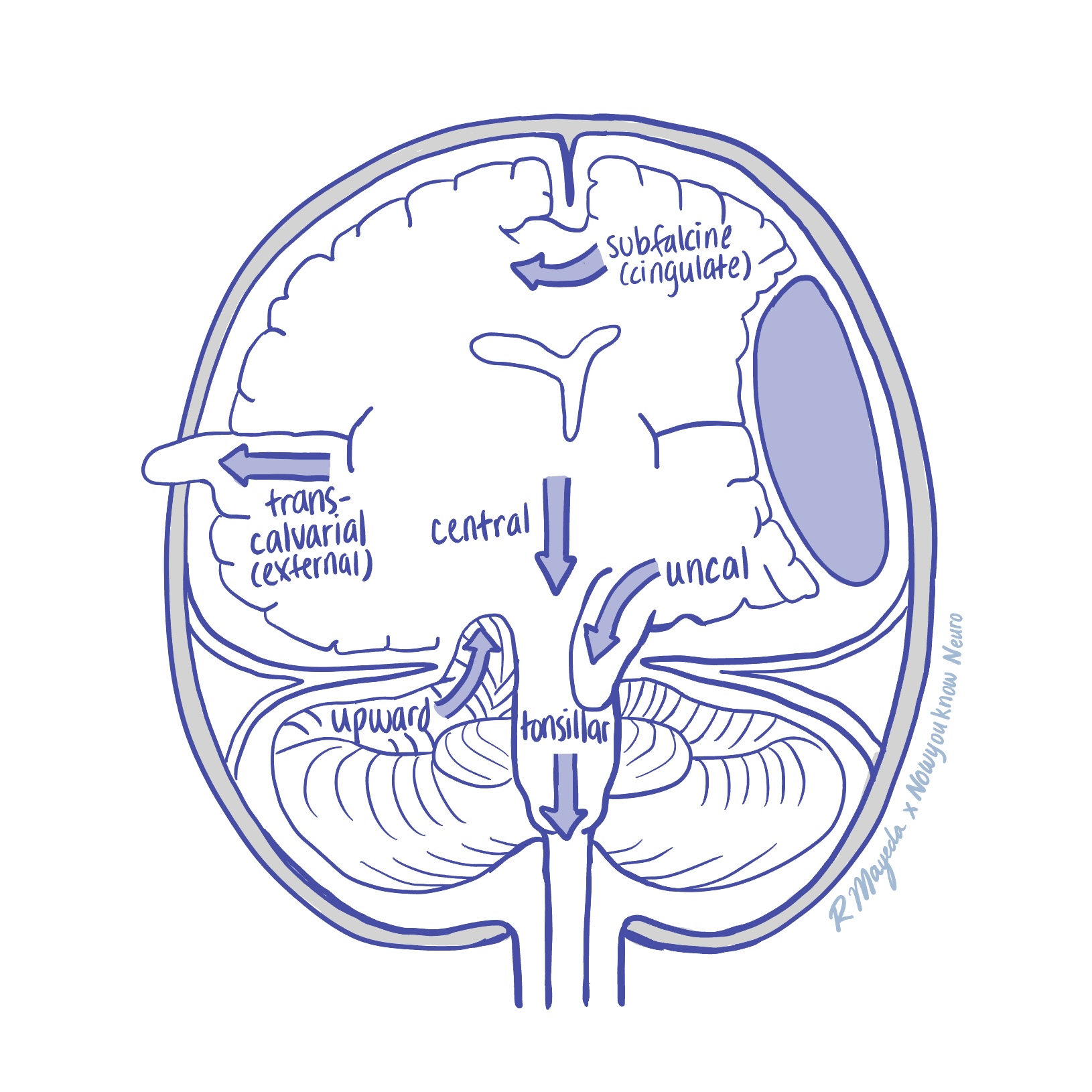 Nowyouknow - 🧠 Intracranial Herniations Explained 🧠 This figure shows ...
