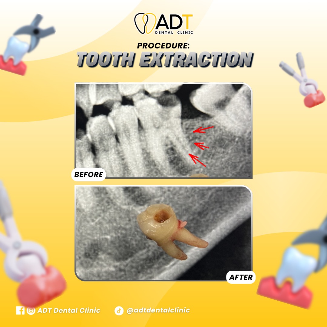 ADT - Tooth extraction is recommended when a tooth is severely damaged ...