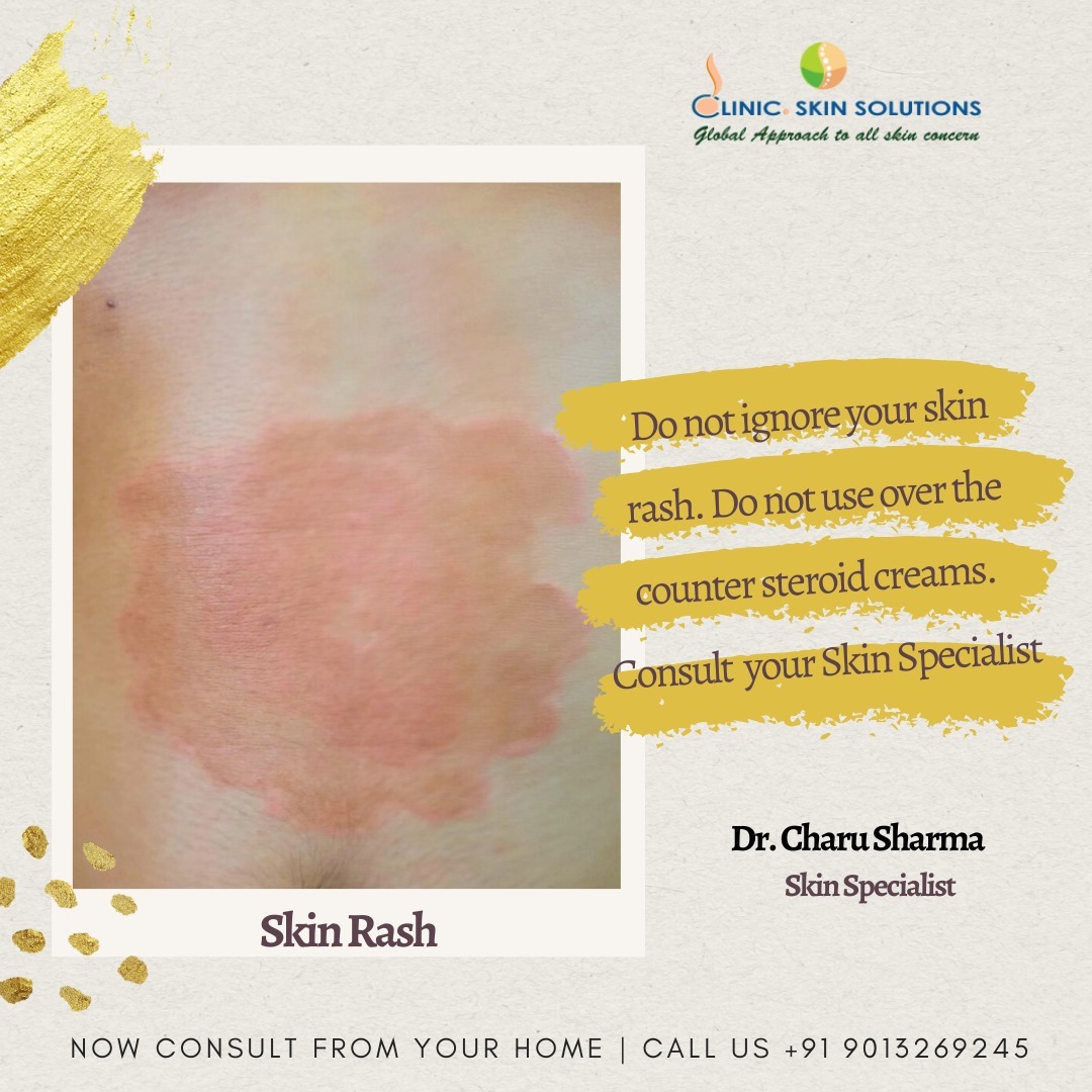 Skin rash can vary in appearance... - Clinic.Skin Solutions | Facebook