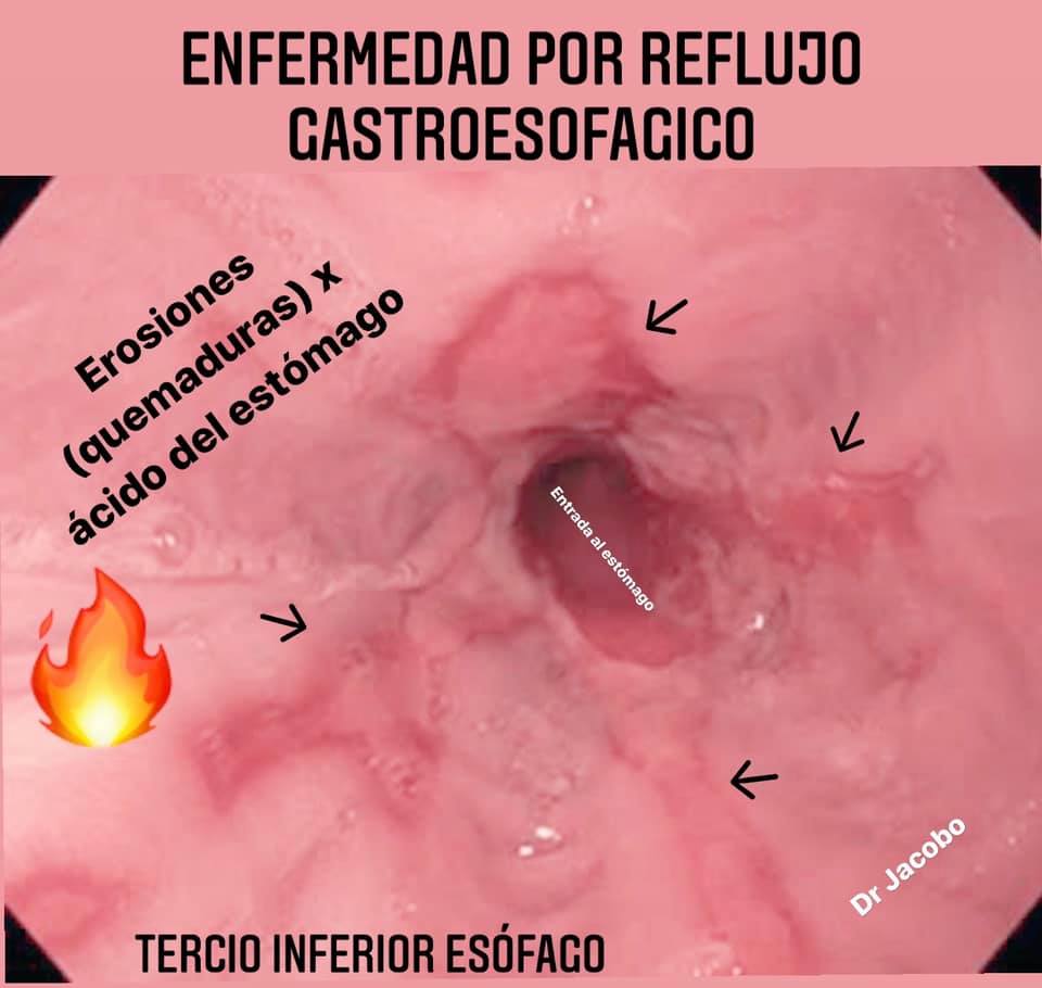 Gastro - 💡 Sabes cuales son los síntomas por ERGE (Enfermedad por ...