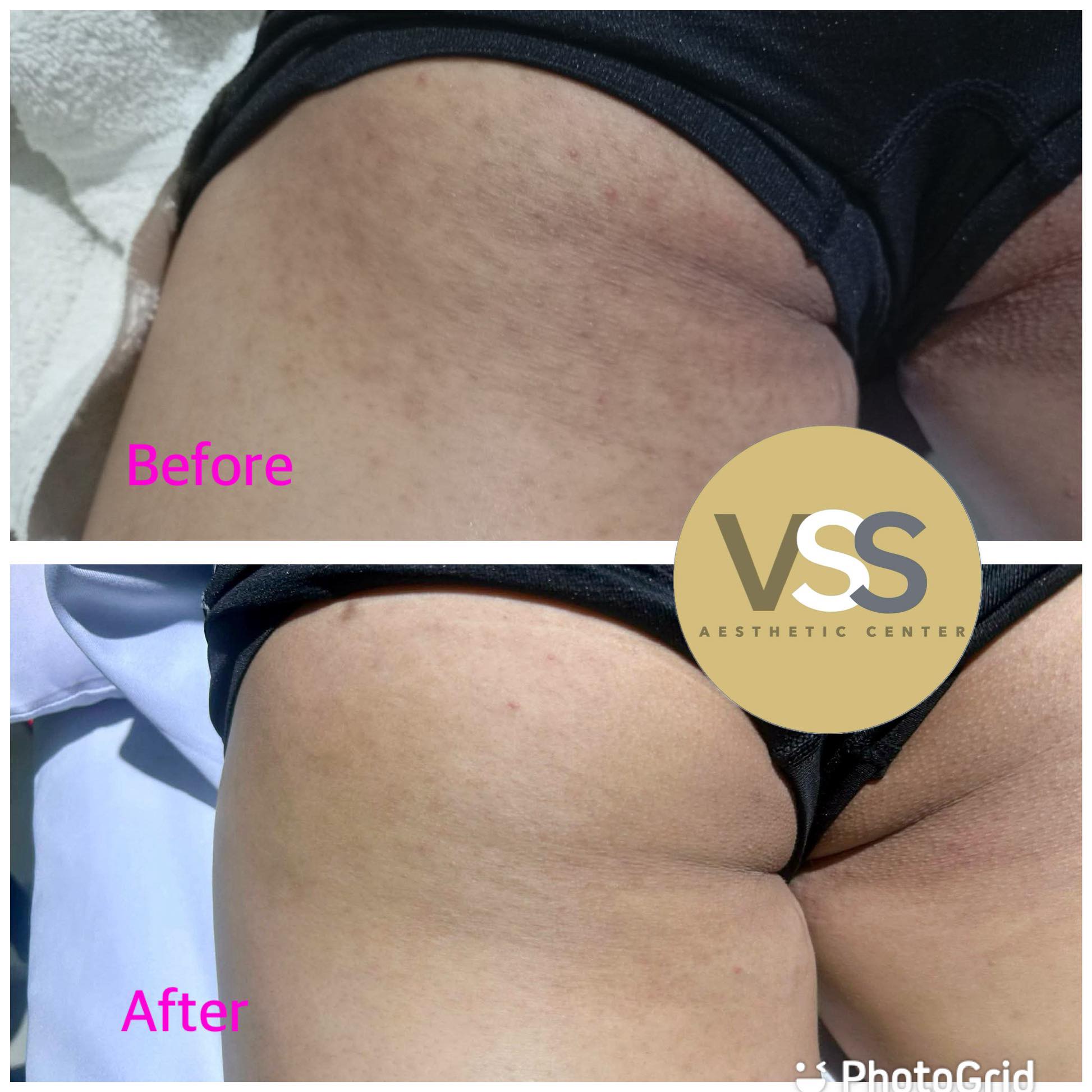 Amazing results after 4 sessions of Carbon Laser treatment on the butt area ✨ This treatment helps improve skin texture, reduce pigmentation, minimize blemishes, and leave the skin smoother, brighter, and more