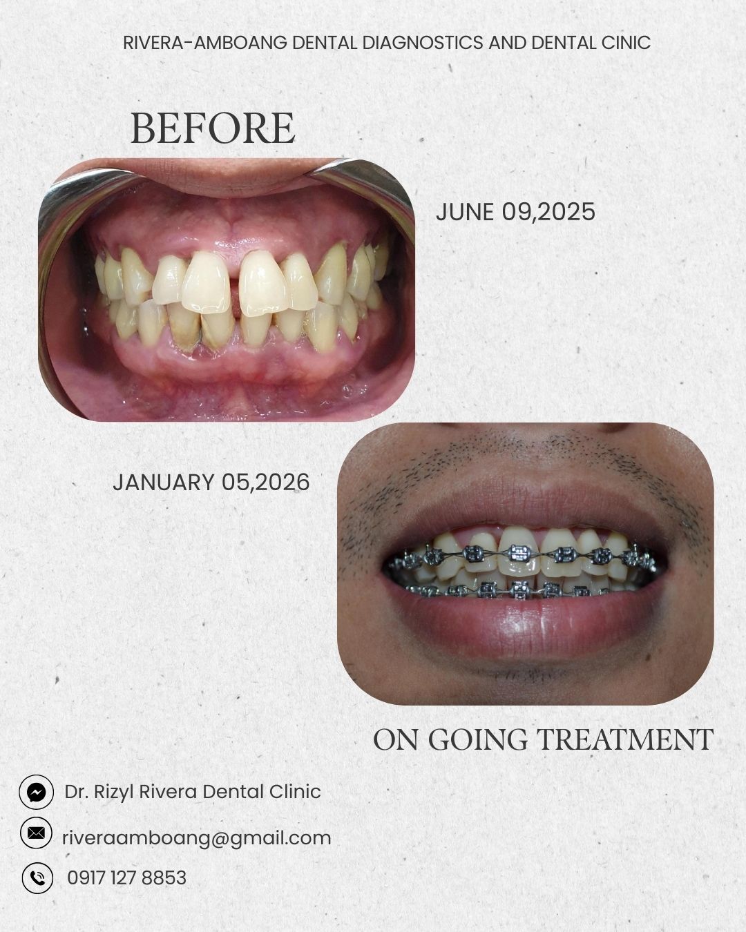 The treatment is still... - Dr. Rizyl Rivera Dental Clinic | Facebook