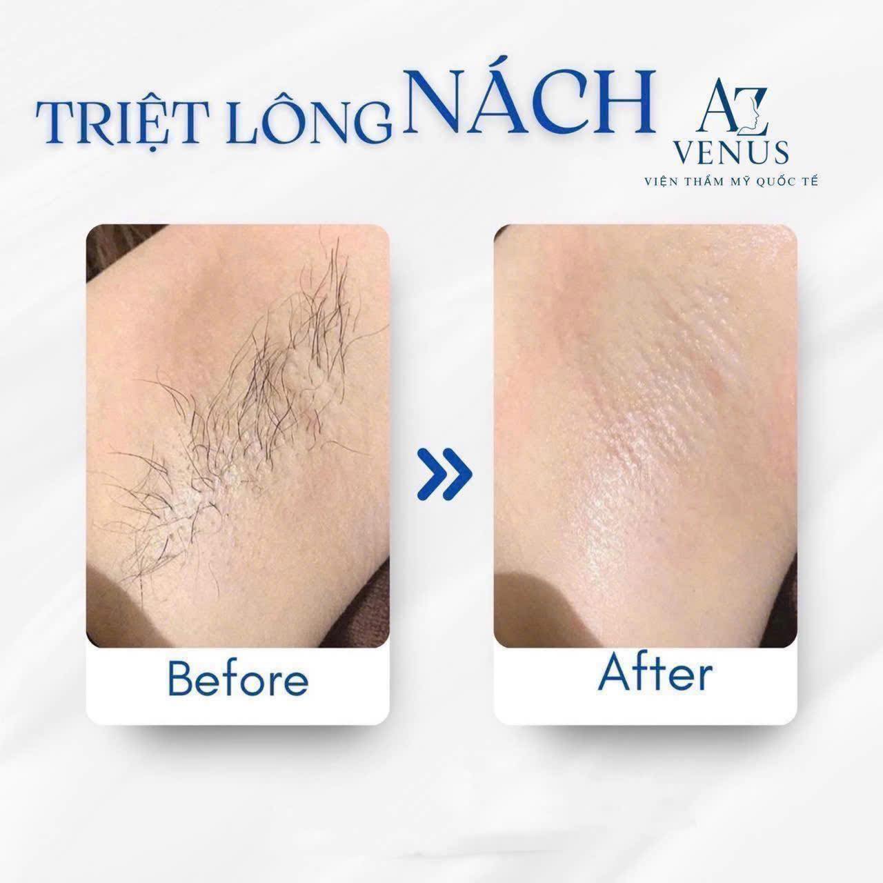 Az Venus - Hifu & Laser Co2 Trẻ Hoá Da | Biên Hòa