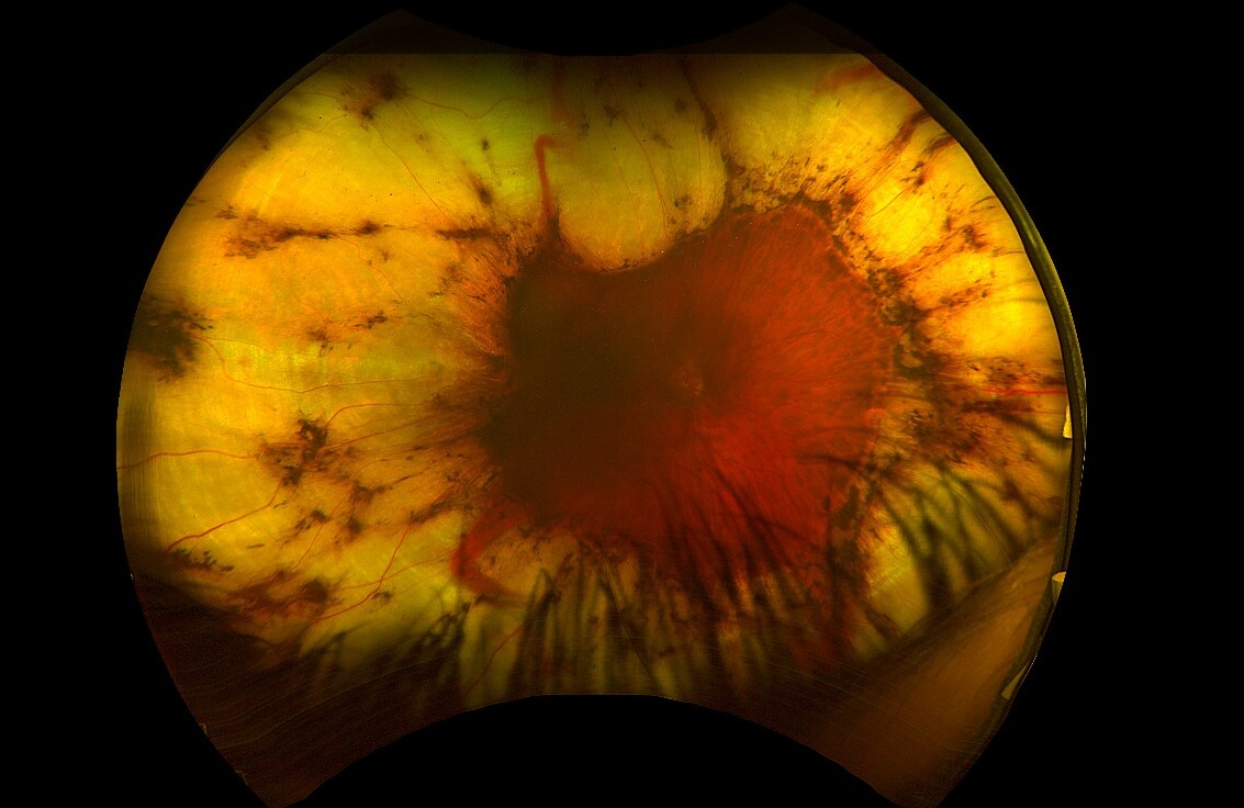 Retinal - February Image of the Month: Vitreous Hemorrhage With Treated ...
