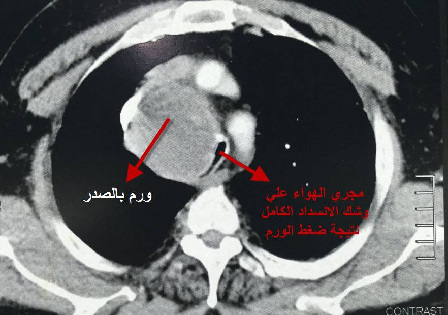 أورام القصبة الهوائية ضيق القصبة الهوائية سرطان القصبة الهوائية جراحة القصبة الهوائية