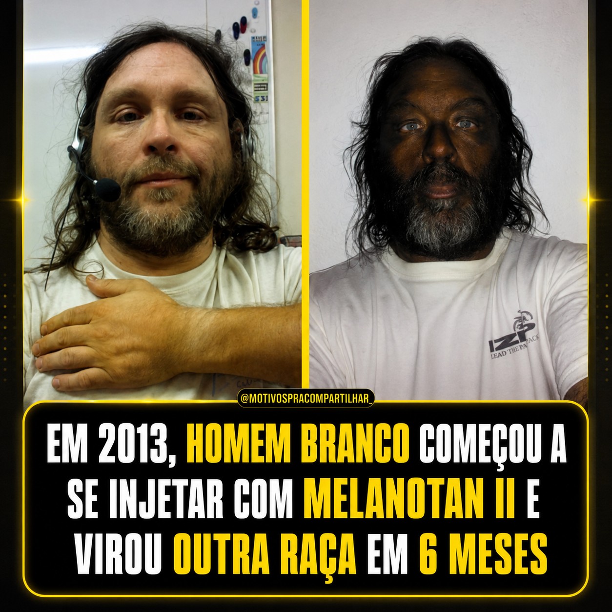 Em 2013, um homem dos Estados Unidos começou a utilizar Melanotan II, uma substância sintética associada ao bronzeamento da pele. O produto não possui aprovação para uso médico em diversos países. Após
