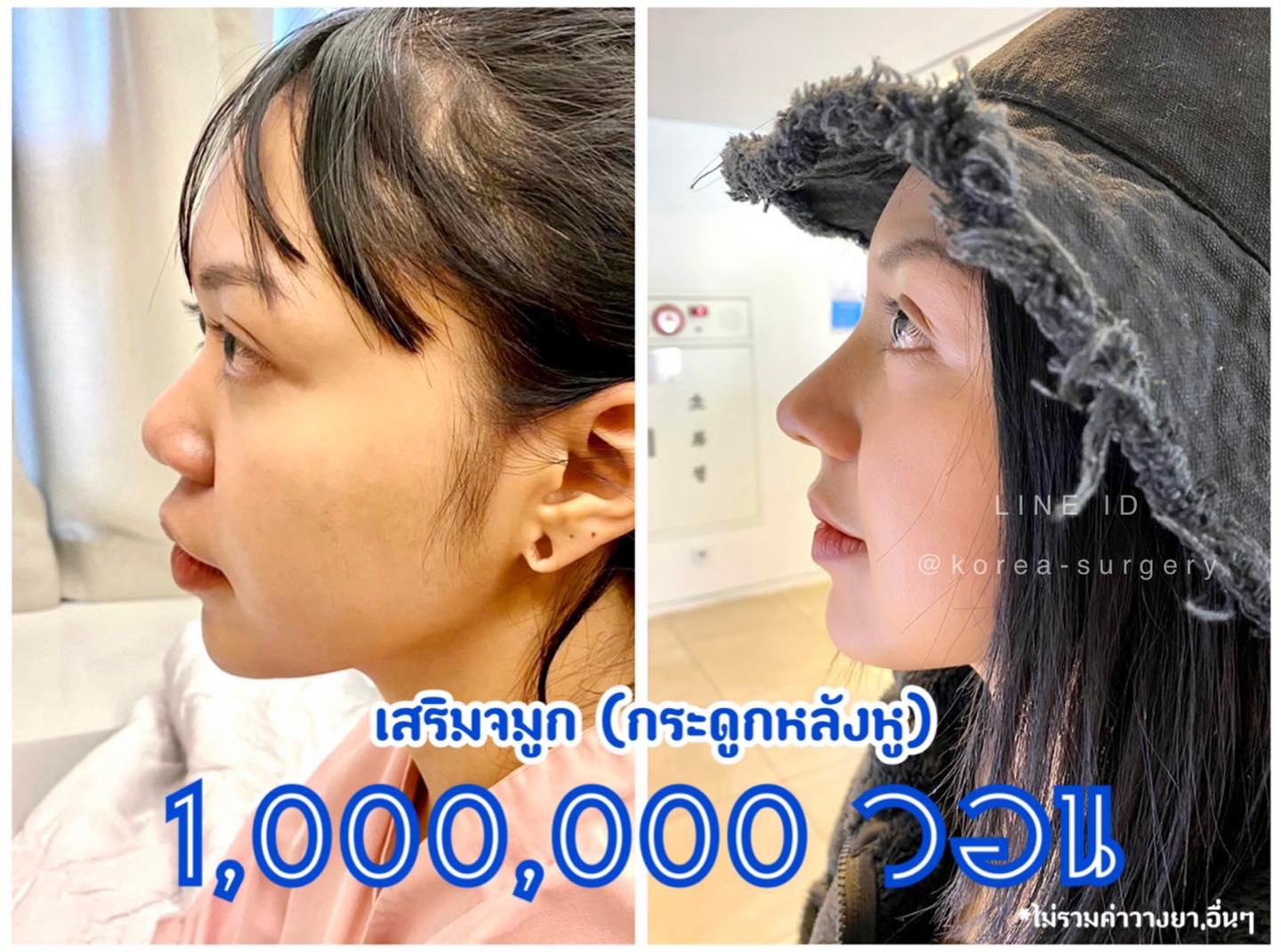 จมูกสวยพุ่งปัง ️... - ศัลยกรรมเกาหลี Korea Surgery Thailand