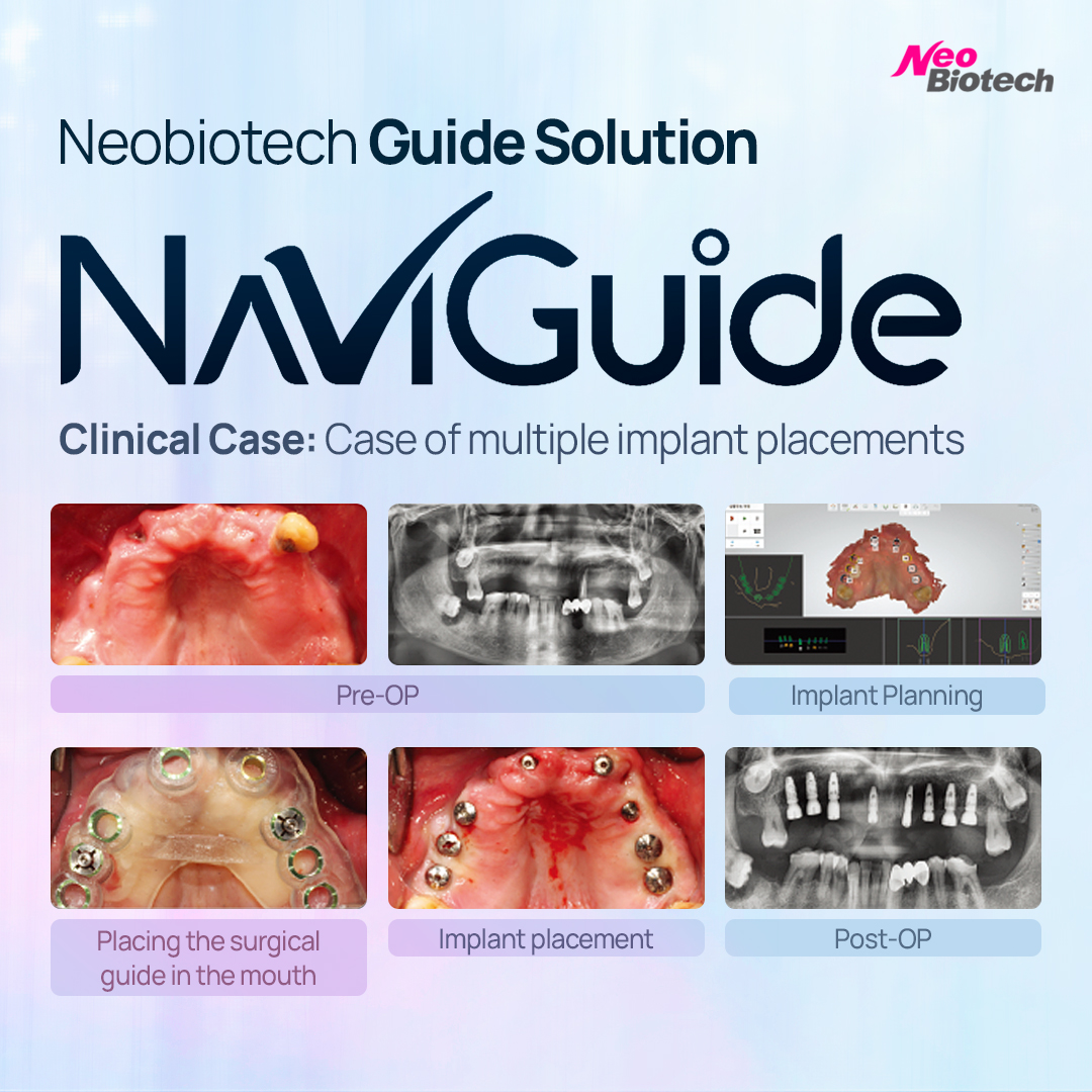 Neobiotech - ★ Neo NaviGuide Clinical Case Neo NaviGuide... | Facebook
