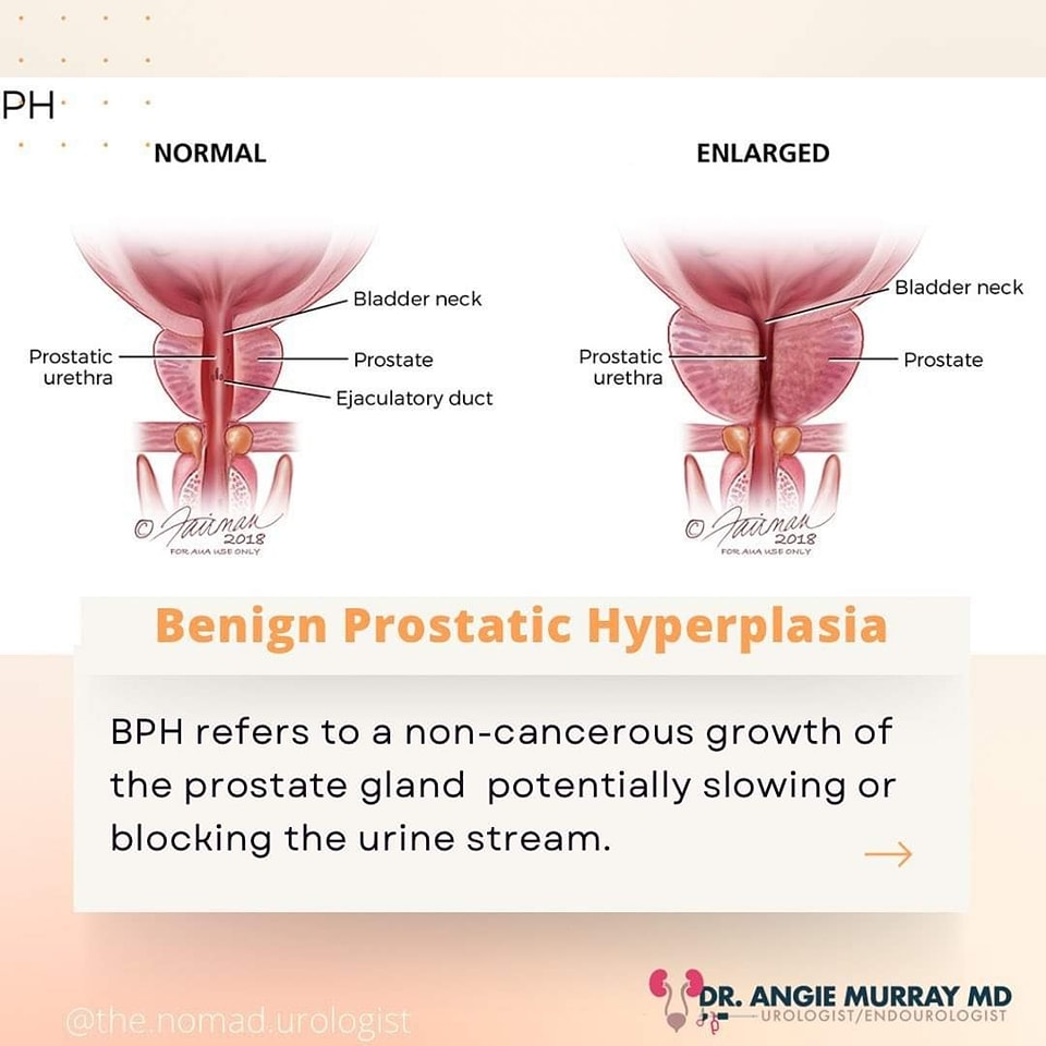 🔹Benign prostatic hyperplasia (BPH) ) is a condition in which your ...