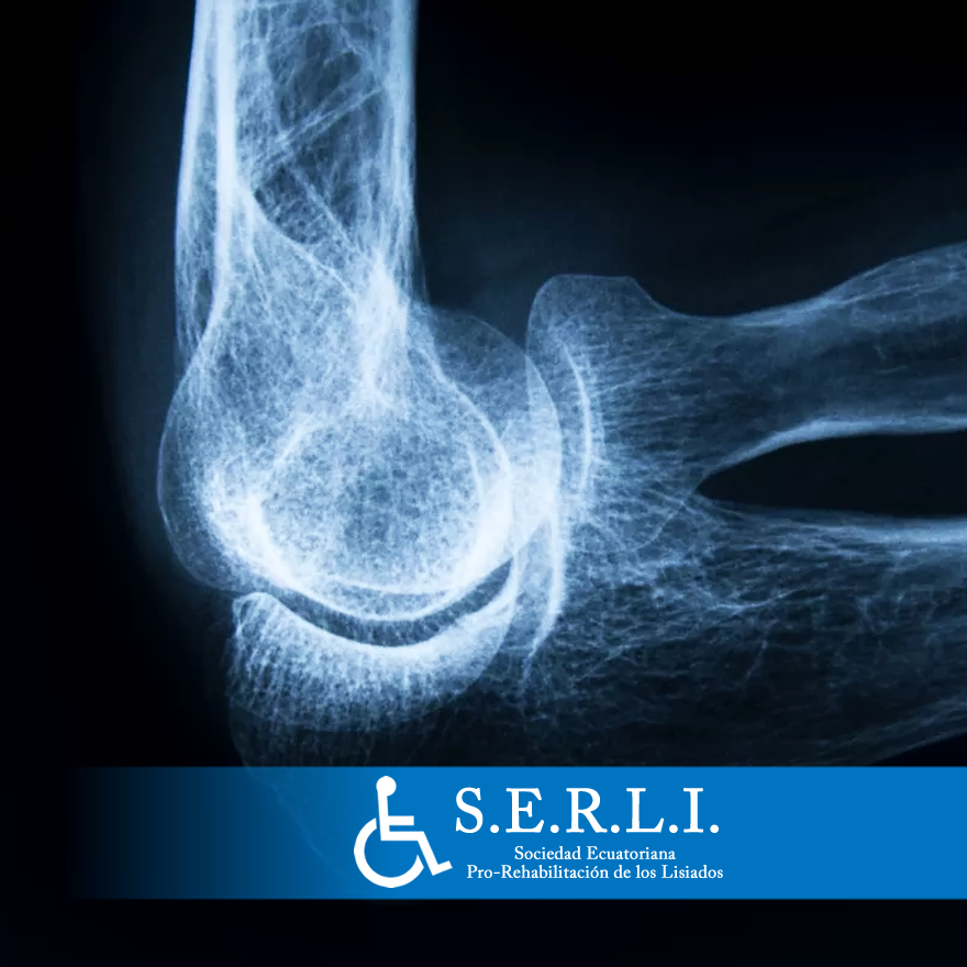 Desde el 12 de agosto #SERLI contará con exámenes de densitometría ósea ...