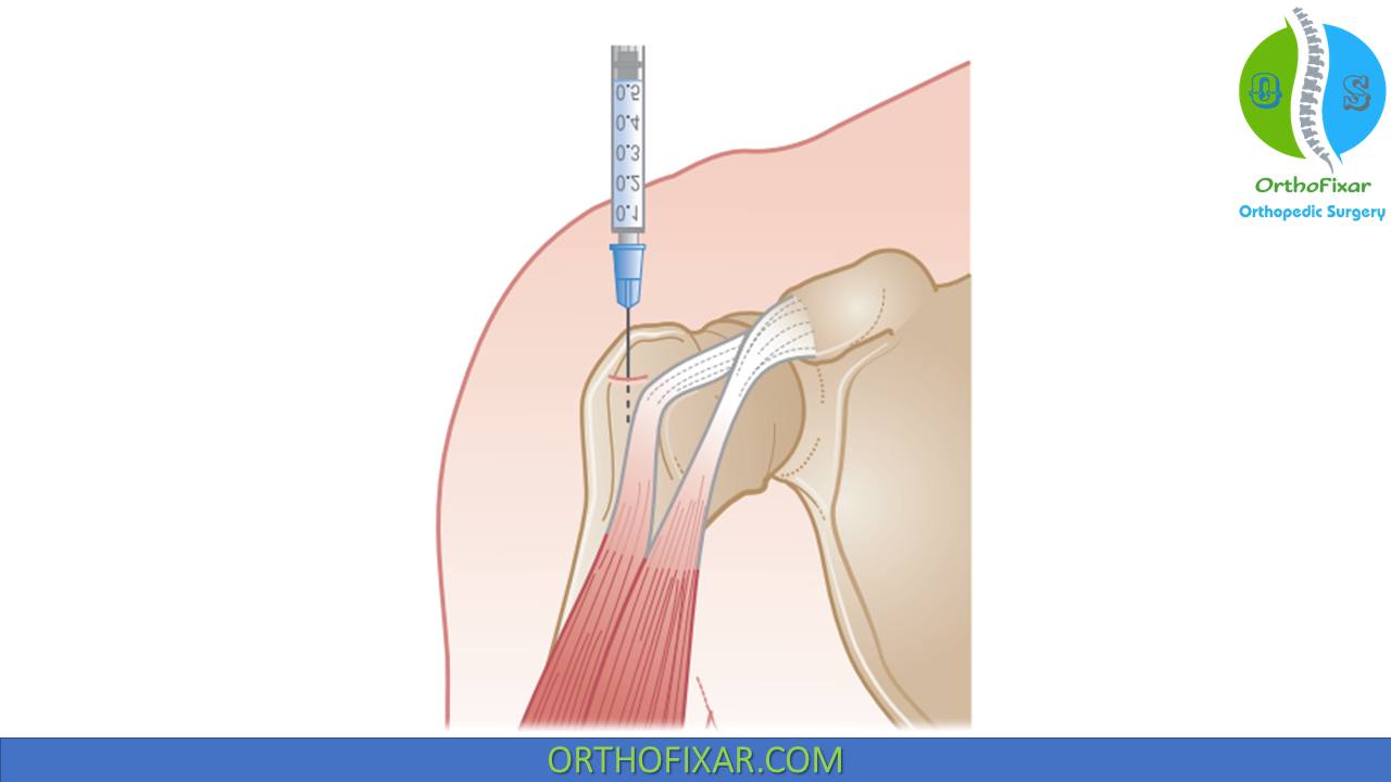 injecting bpc 157 into bicep for Tendonitis: Targeting the Right Spot injecting bpc 157 into bicep