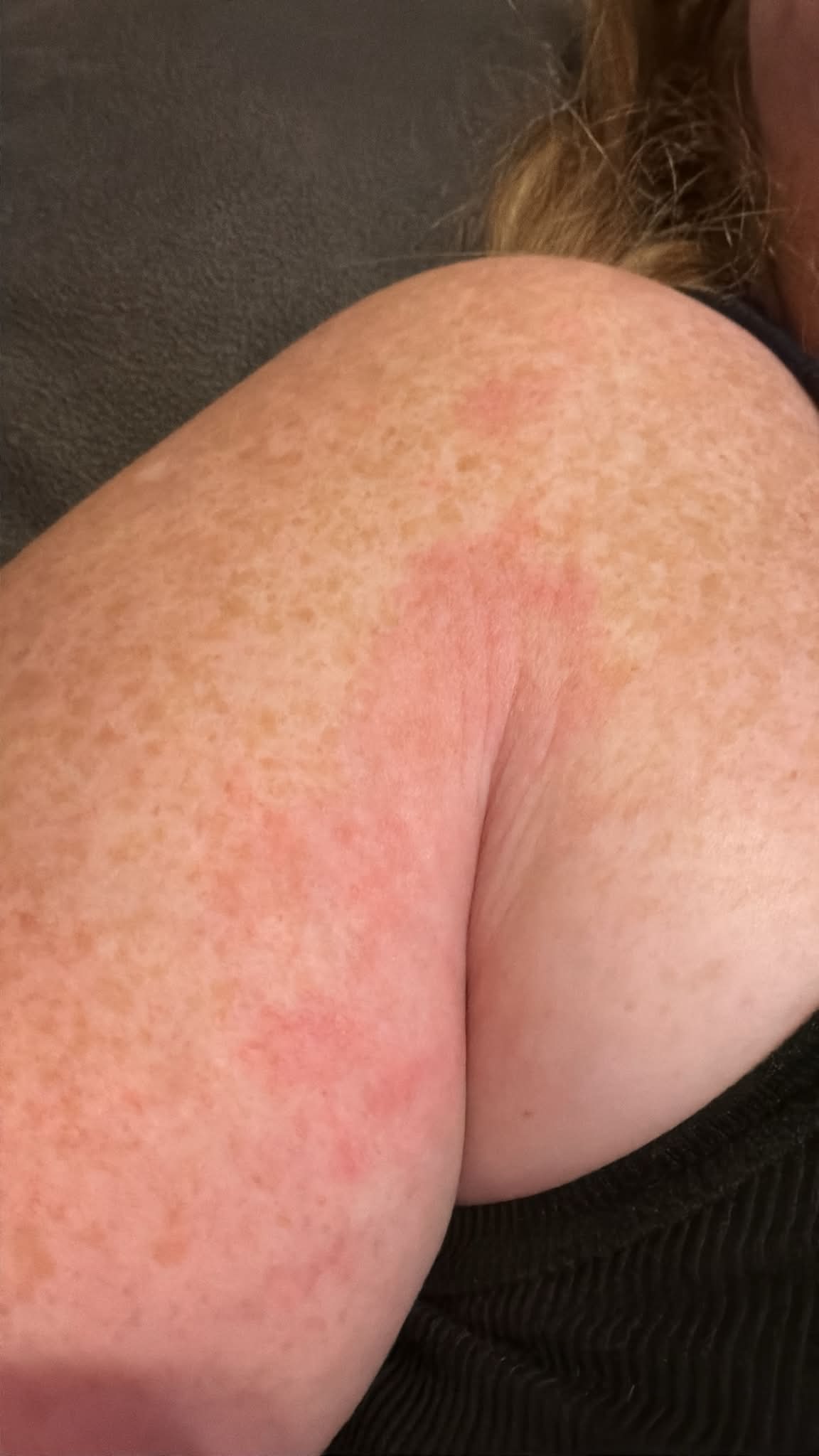 itchy rash after b12 injection Has anyone experienced redness or itching around the area of injection? I'm on my third dose of 12.5 and this is the second time I've developed these symptoms. Always used my stomach Is animal-grade vitamin B12