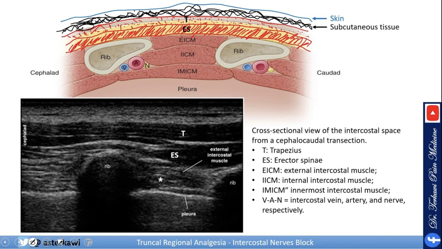 Intercostal nerve block and... - Dr. Terkawi Pain Medicine | Facebook