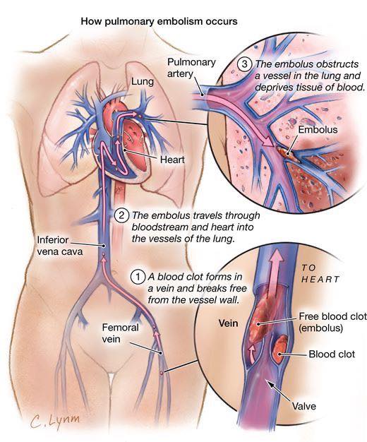 Dr. Muhammed - Corticospinal Tract ️ | Facebook