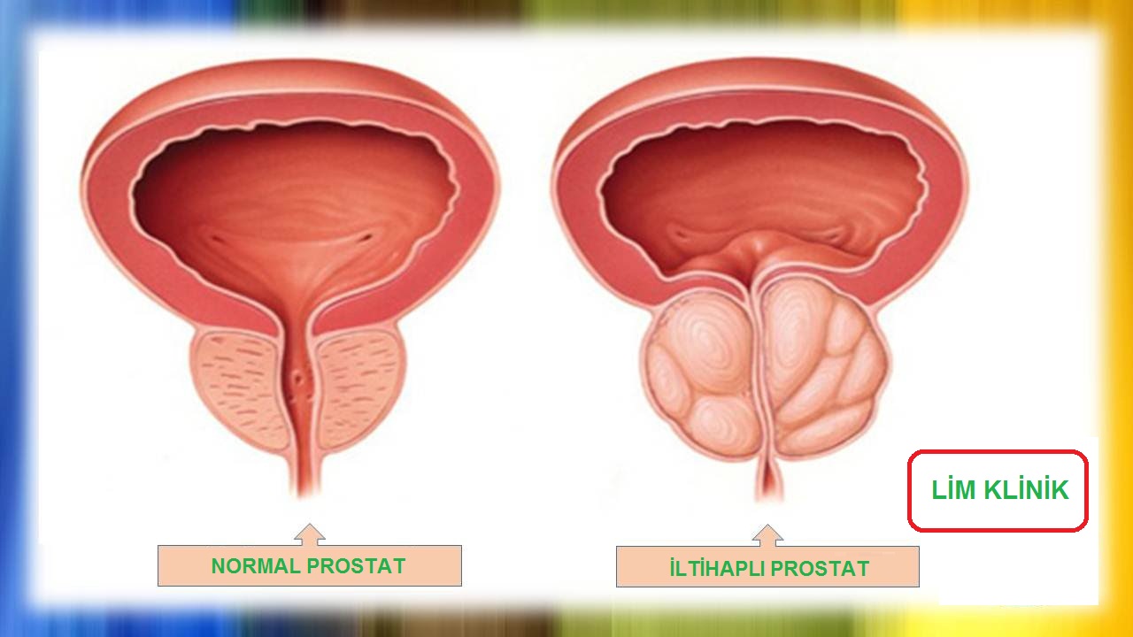 Kronik Prostatit