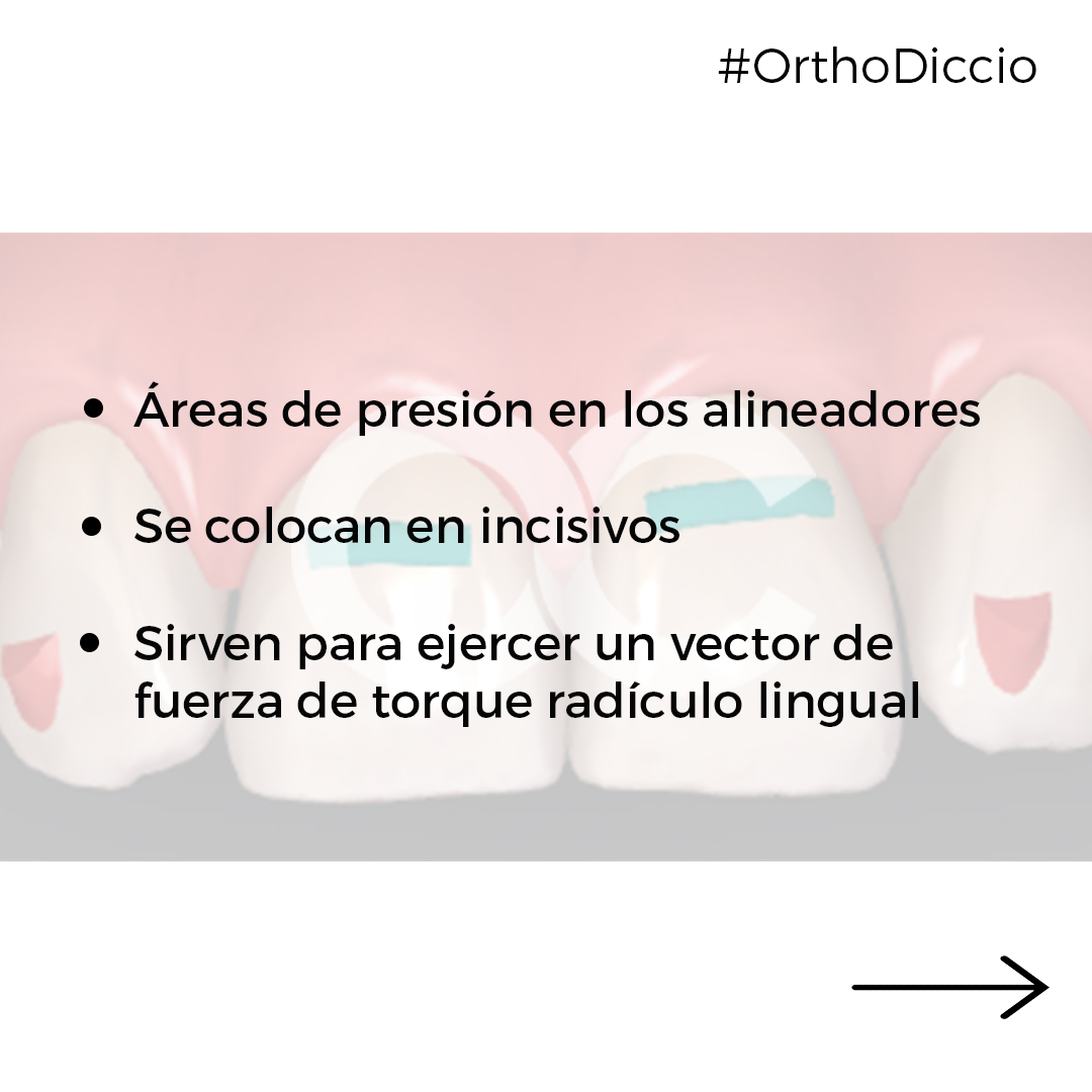 🤔¿Qué son los Power Ridges? 👉🏻Los... - OrthoClub Academy | Facebook
