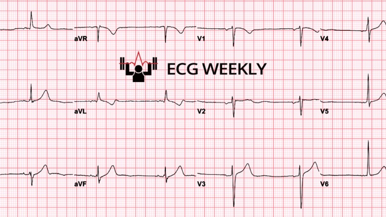 ECGWeekly - A 62-yo man presents to the emergency department with acute ...