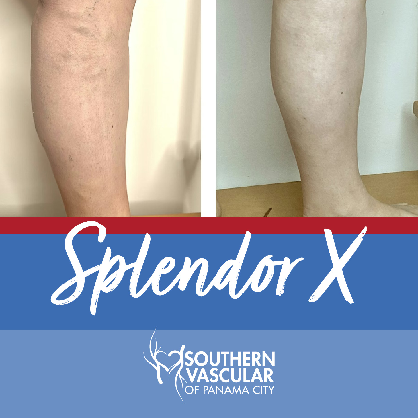 glutathione varicose veins Visible results you can see. Before-and-after results from vein treatments using our Splendor X technology, designed to target safely and effectively. Book a consultation with us today! (850) 532-6303 live_pdp Amount:50mg Gray Hair Glow Kit