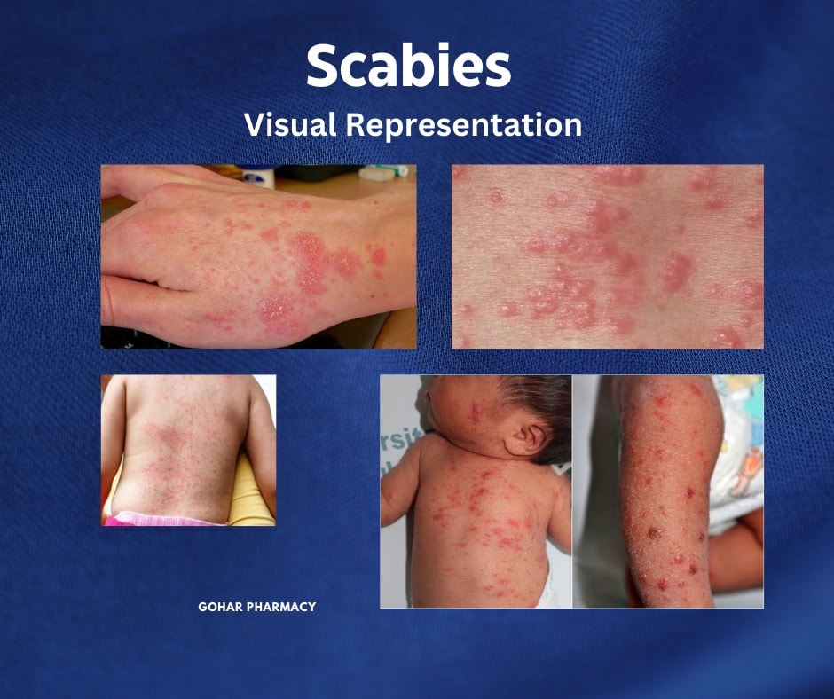 Gohar Pharmacy - Scabies is a common skin disease these...