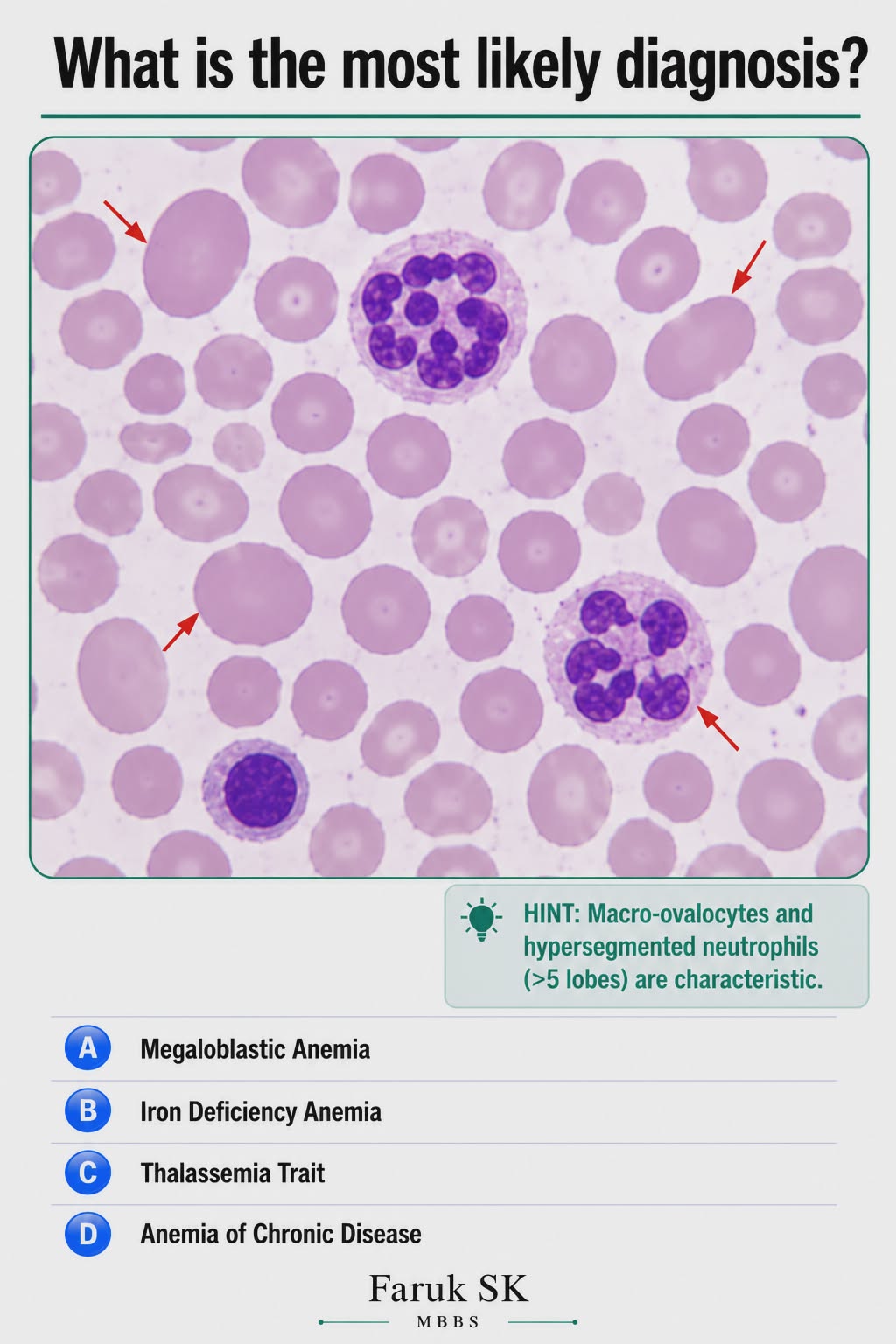 💐 Megaloblastic Anemia (Folate, Vitamin B12 Deficiency) 💐 💐 Clinical Features💐 🔸Vitamin B12 deficiency: Neurological manifestations due to spinal cord involvement, such as difficulty maintaining posture and paresthesia in hands and feet