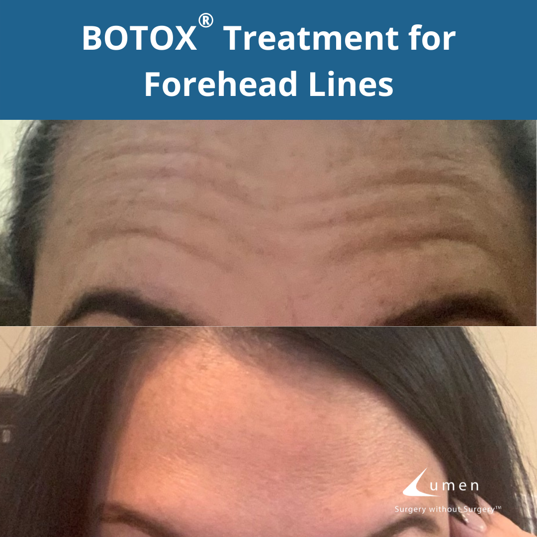 The power of 30 units of BOTOX on these... - The Lumen Center | Facebook