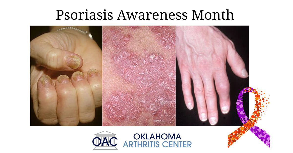 glutathione pills psoriasis August is Awareness Month: Understanding Psoriatic Arthritis dna health bpc 157 Korean Skin Size:1 Bar