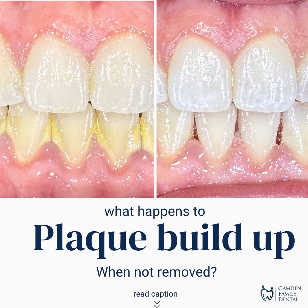Camden - 🦷 What happens when plaque isn’t removed? Plaque is a sticky ...