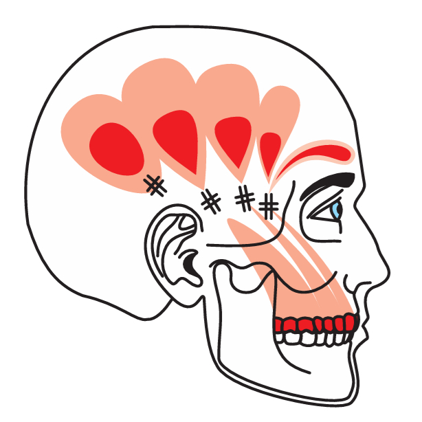 British - What a pain! Trigger points in temporalis This striking image ...