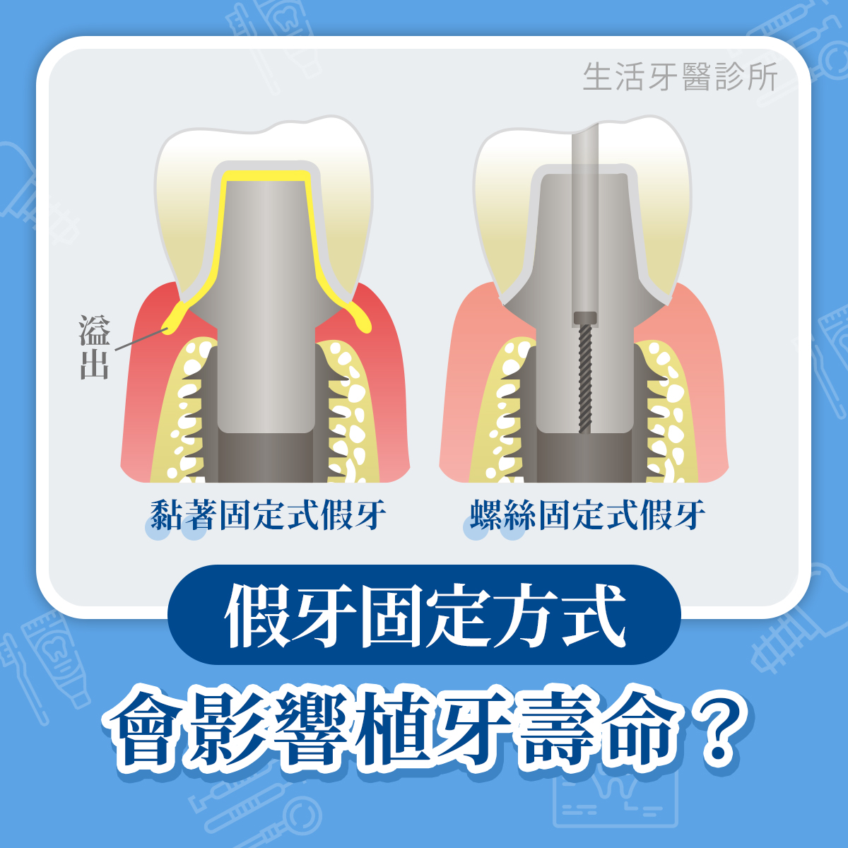生活牙醫診所 - 南投竹山店 - 關於假牙固定在植體上有兩大方法 ️ 一是最通俗也最簡易操作的 #黏著固定法... | Facebook
