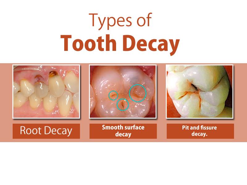 Types of #tooth #decay: -... - DNTL Studio by Amin and Desai | Facebook