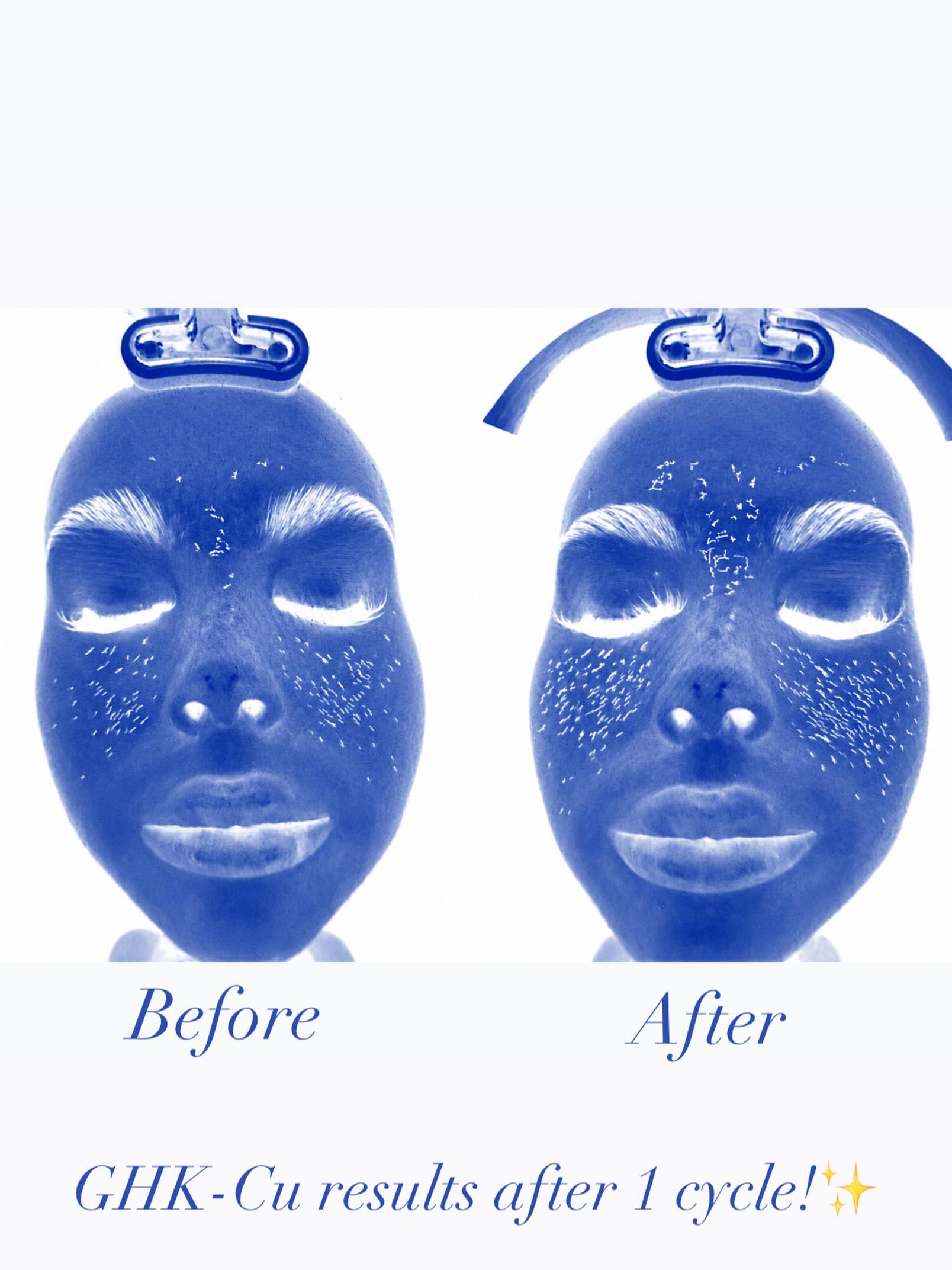 GHK-Cu peptide therapy for skin rejuvenation
