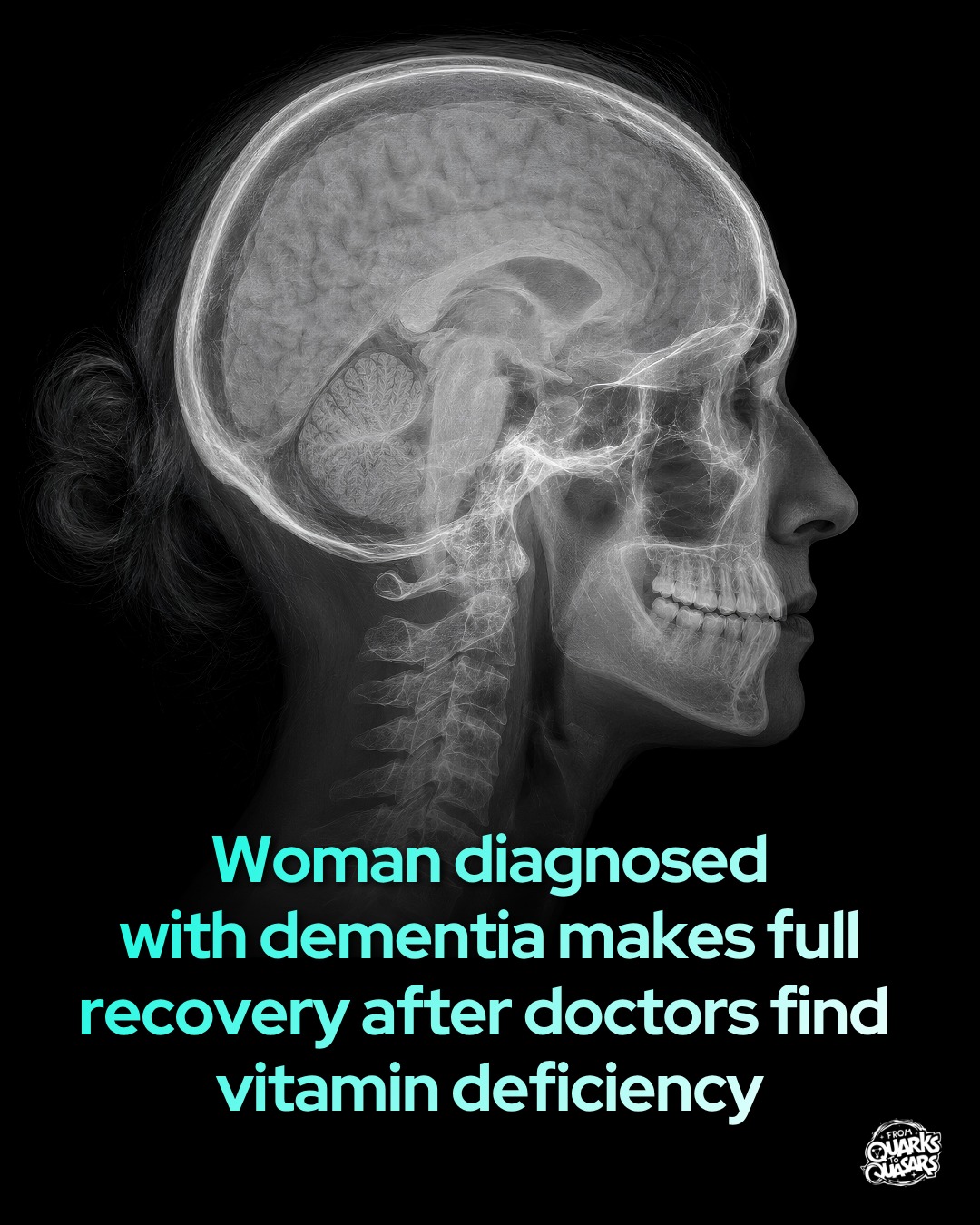 A B12 deficiency can sometimes cause dementia-like symptoms. A woman diagnosed with dementia for five years made a remarkable recovery after doctors found a vitamin deficiency. The 61-year-old woman had gradually lost