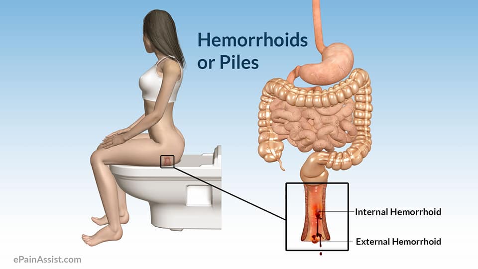 Baraka Makali What Is Hemorrhoid Or Piles The Rectal Facebook