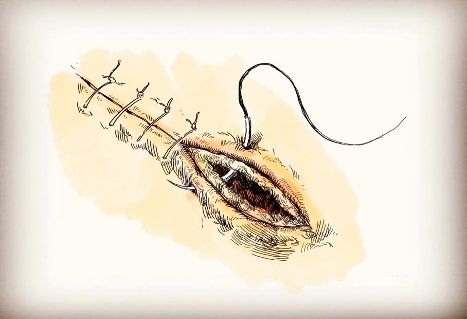 Solaxin。手拉心 - [ Suture anatomy | 縫線解剖學]﻿﻿ ﻿ 通常手術縫線（suture) 用幾個「0」來代表粗細 ...