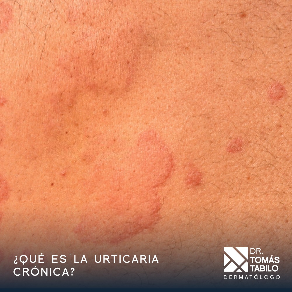 ¿Sabías que la urticaria... - Dermatólogo Dr. Tomas Tabilo