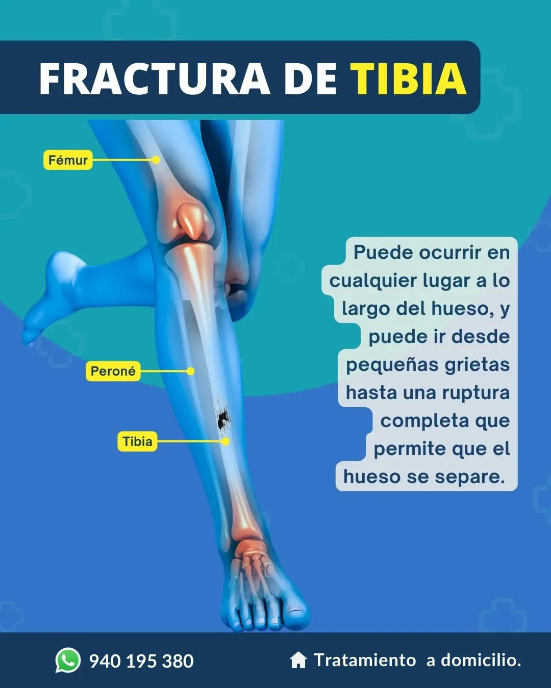 Physio - ⏩Fractura de tibia⏪ Una fractura tibial puede ocurrir en ...