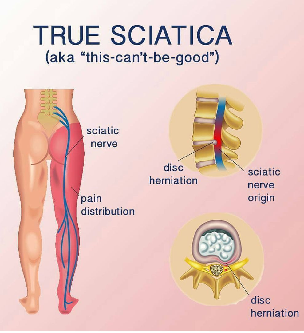 [ TRUE SCIATICA ] True... - PBS Rehabilitation Centre | Facebook