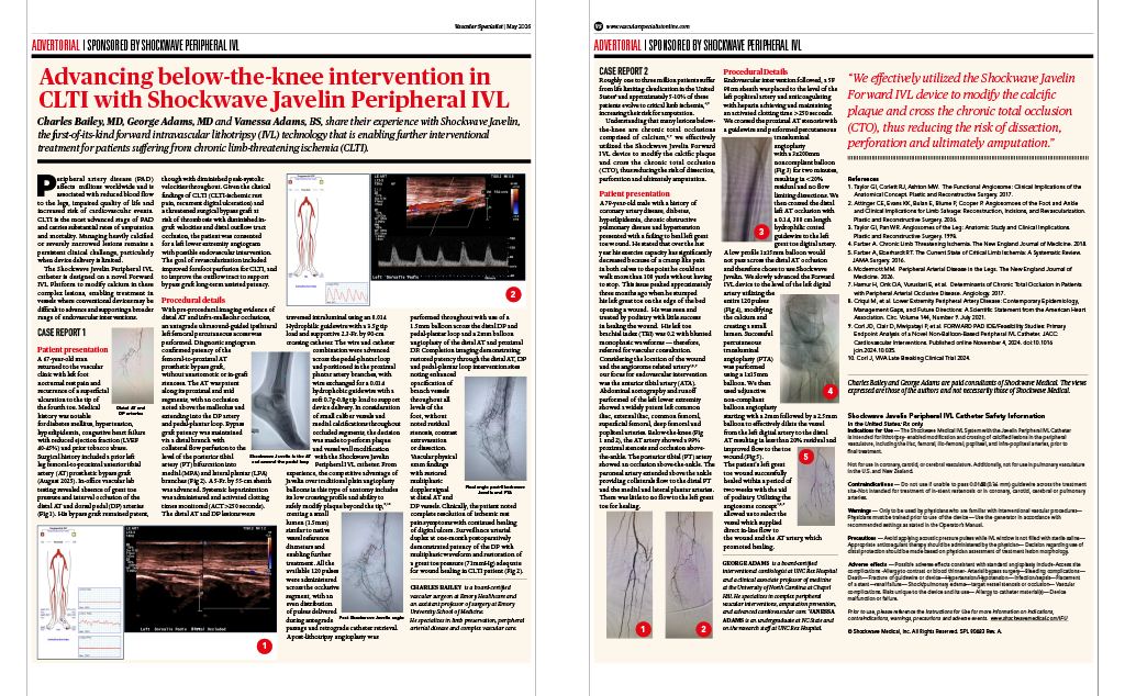 Shockwave Javelin for below-the-knee interventions in CLTI