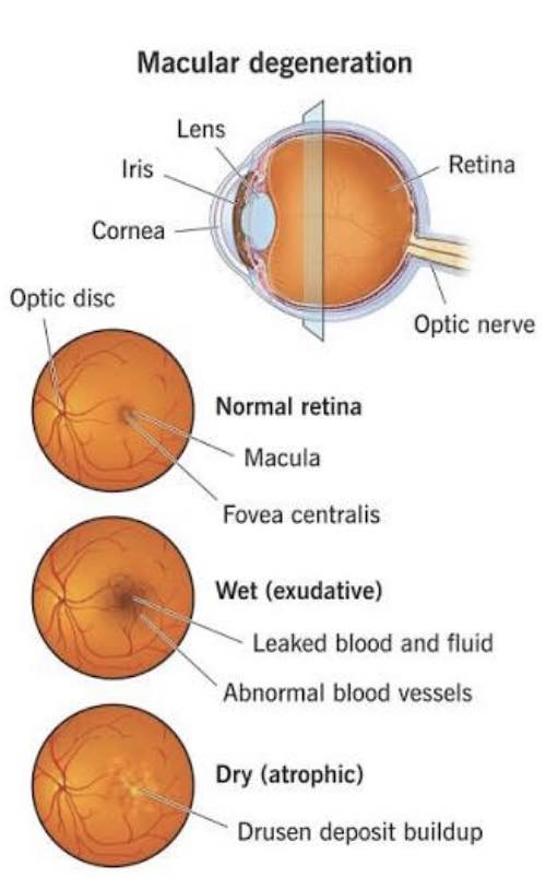 Coeur - ABC’s of optometry M is for macular degeneration Macular ...