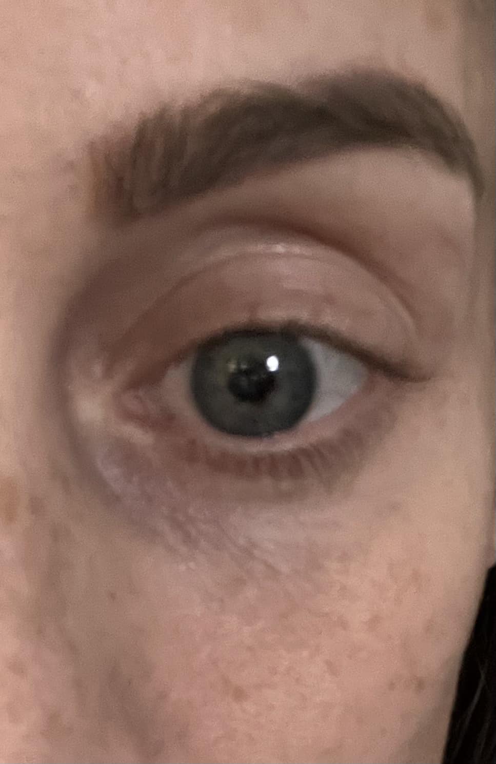 Dark circles under eyes after implants?
