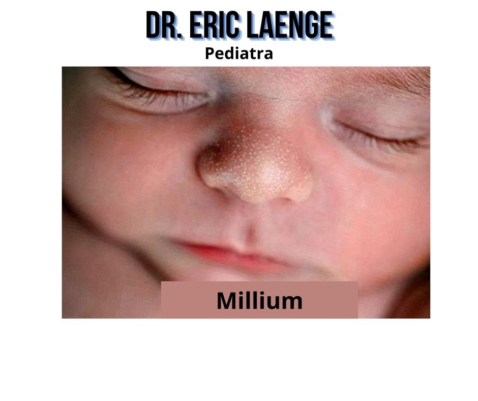 Dr Eric Laenge Pediatra Que Es El Millium Facial En Los Recien Nacidos Si Tu Bebe Tiene Granitos Blancos En La Cara El Torso O La Boca No Te Preocupes Te