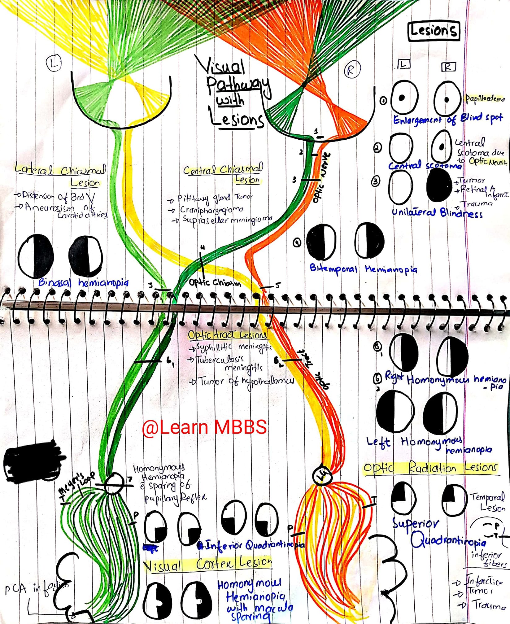 Learn MBBS - Visual pathway 🙌 lesions are important...