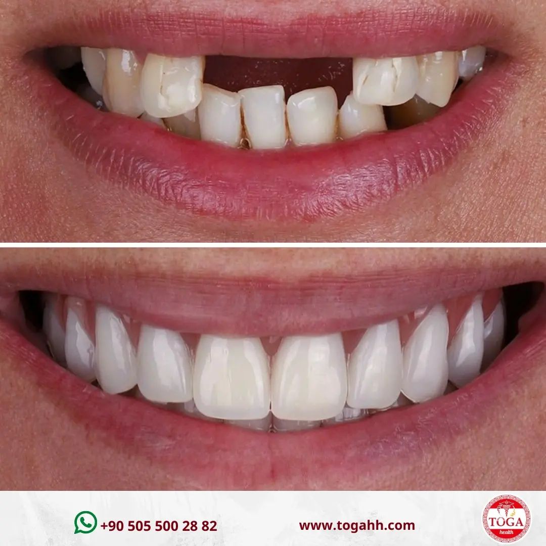 Toga - Are Dental Implants permanent?🔍 Yes, the implant itself is ...