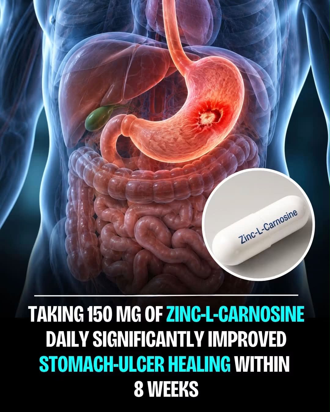 Zinc L-carnosine is a unique compound that combines the essential mineral zinc with the amino acid derivative L-carnosine. Unlike regular zinc supplements, it adheres to the stomach and intestinal lining, allowing zinc